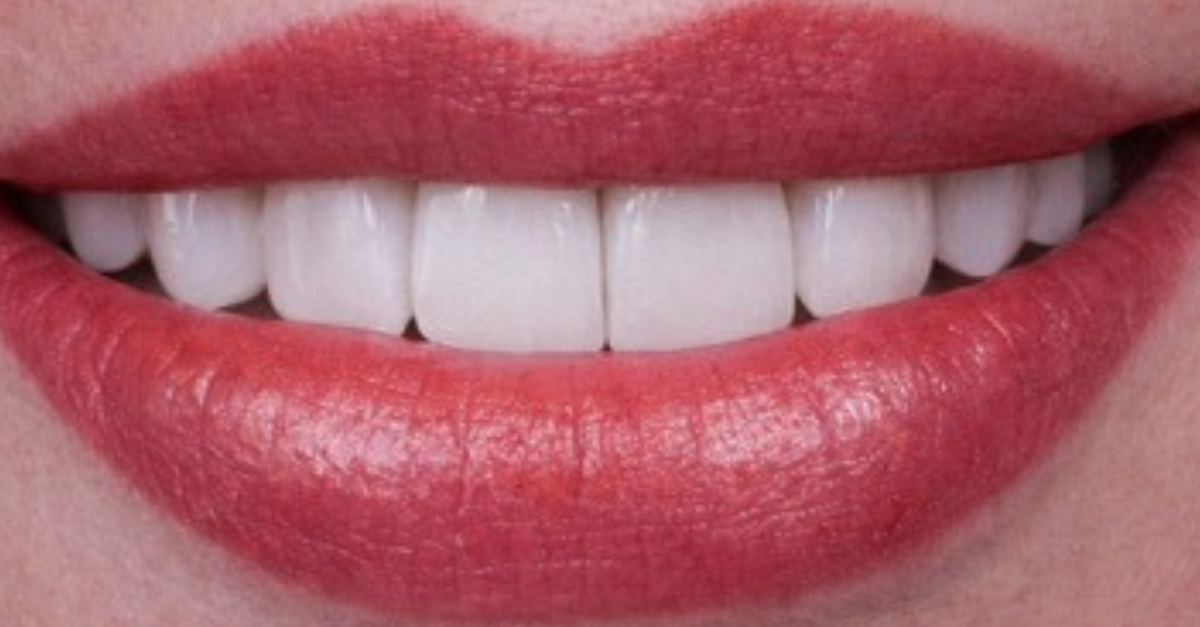 Birdwell & Mutlak Dentistry smile makeover after — Thompson's Station, TN