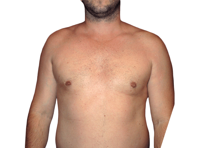 Premiere Surgical Arts liposuction after — Houston, TX