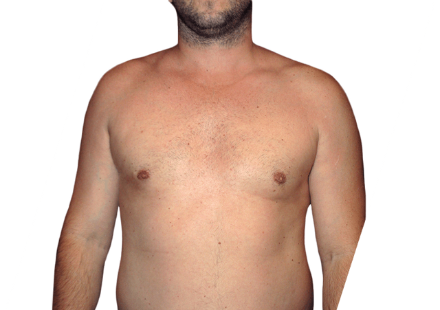 Gynecomastia Surgery after at Premiere Surgical Arts in Houston, TX