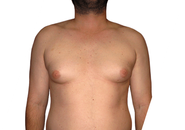Gynecomastia Surgery before at Premiere Surgical Arts in Houston, TX