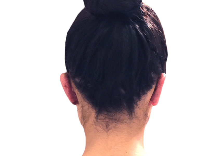 Premiere Surgical Arts otoplasty after — Houston, TX