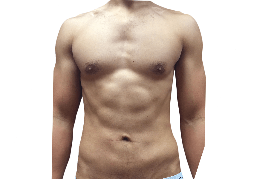 Premiere Surgical Arts liposuction after — Houston, TX