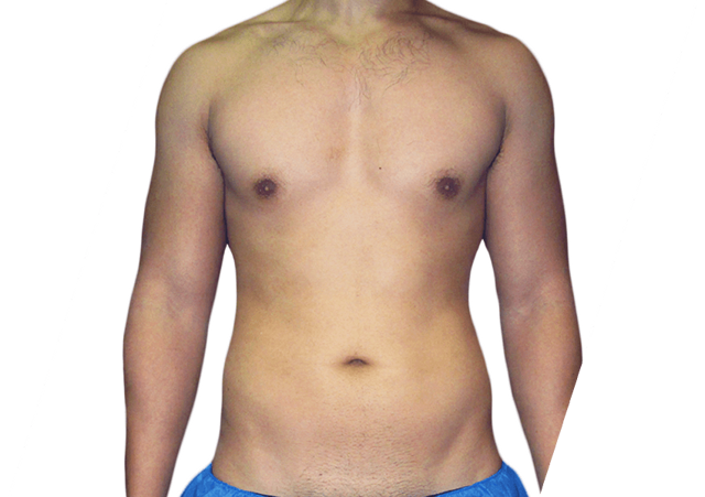 Liposuction before at Premiere Surgical Arts in Houston, TX