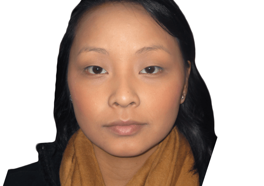 Premiere Surgical Arts blepharoplasty after — Houston, TX