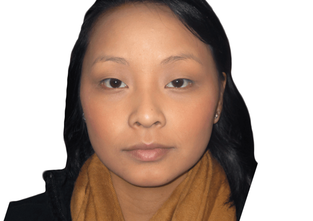 Blepharoplasty after at Premiere Surgical Arts in Houston, TX