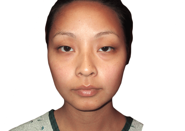 Blepharoplasty before at Premiere Surgical Arts in Houston, TX