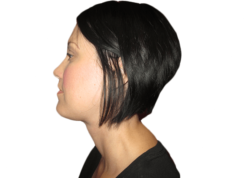 Premiere Surgical Arts neck lift after — Houston, TX