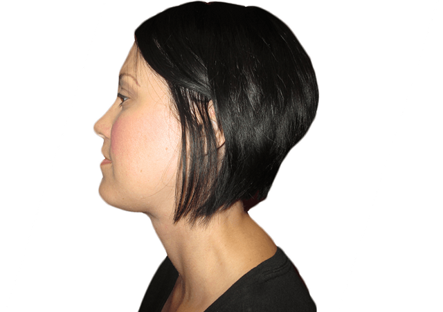 Neck Lift after at Premiere Surgical Arts in Houston, TX