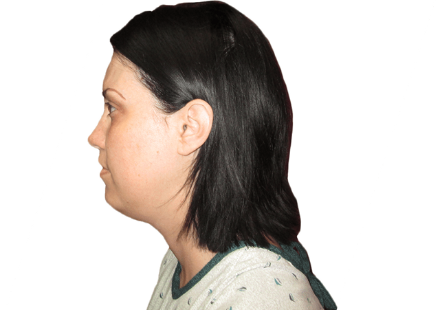 Neck Lift before at Premiere Surgical Arts in Houston, TX
