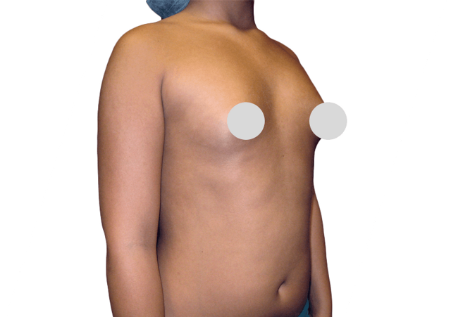 Breast Augmentation before at Premiere Surgical Arts in Houston, TX