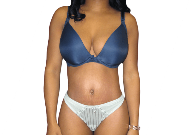 Mini Tummy Tuck after at Premiere Surgical Arts in Houston, TX