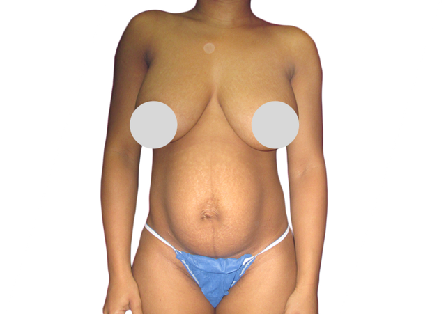 Mini Tummy Tuck before at Premiere Surgical Arts in Houston, TX