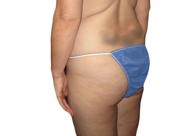 Brazilian Butt Lift before at Premiere Surgical Arts in Houston, TX