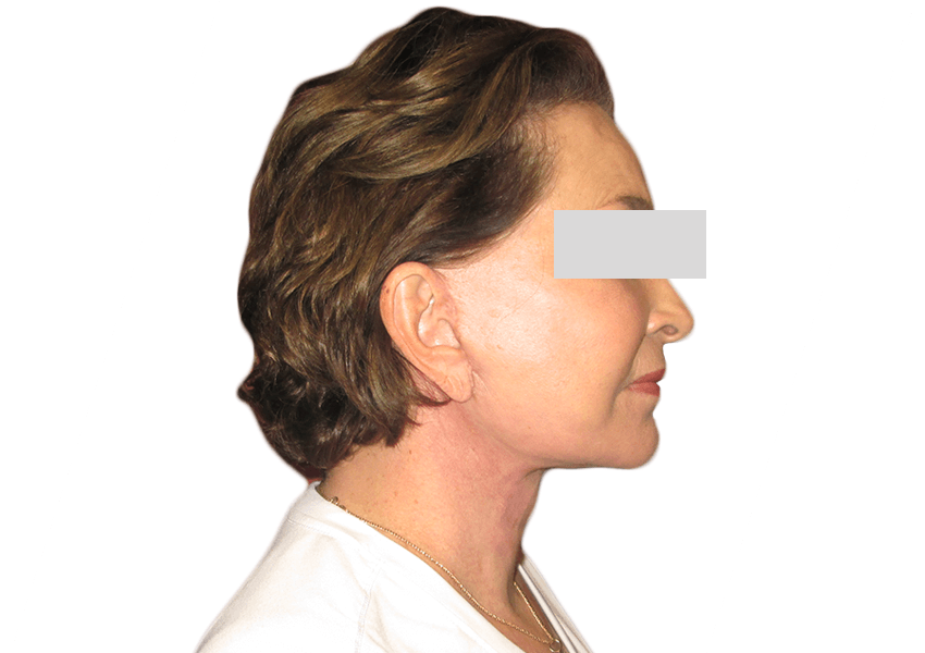 Premiere Surgical Arts facelift after — Houston, TX