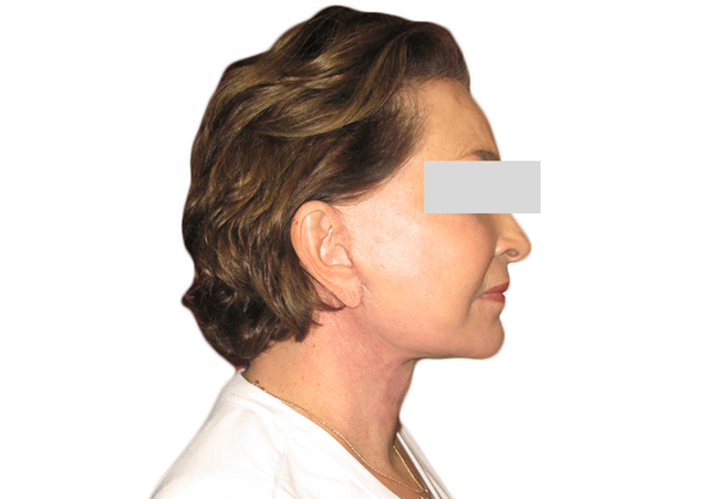 Facelift after at Premiere Surgical Arts in Houston, TX