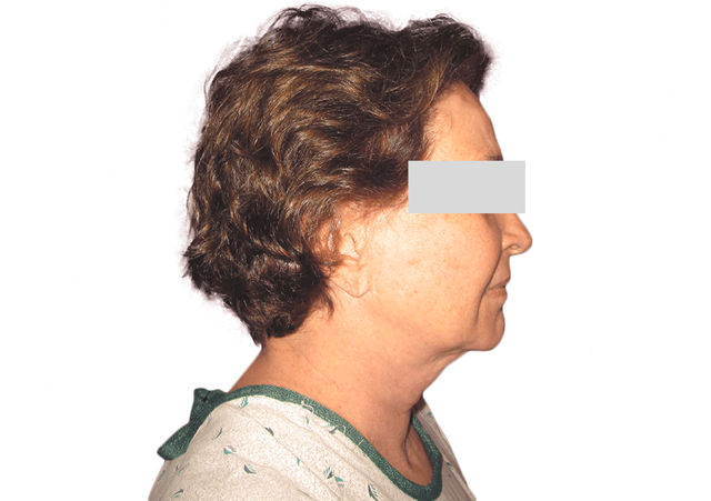Facelift before at Premiere Surgical Arts in Houston, TX