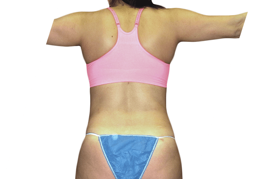 Premiere Surgical Arts liposuction after — Houston, TX