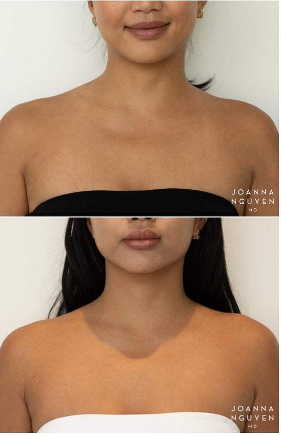 JoAnna Nguyen, MD botox result — West Hollywood, CA