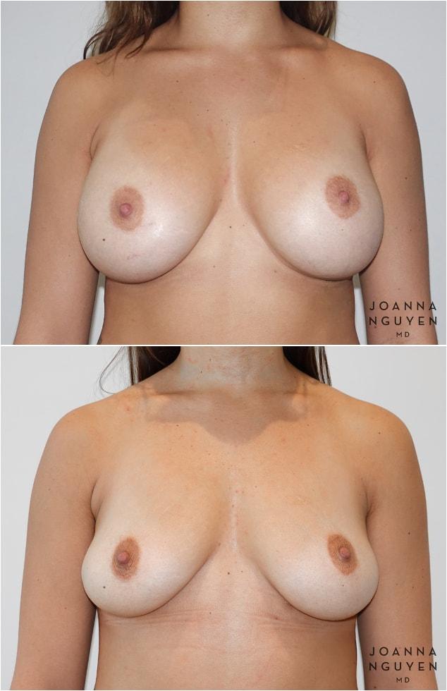 Breast Lift result at JoAnna Nguyen, MD in West Hollywood, CA