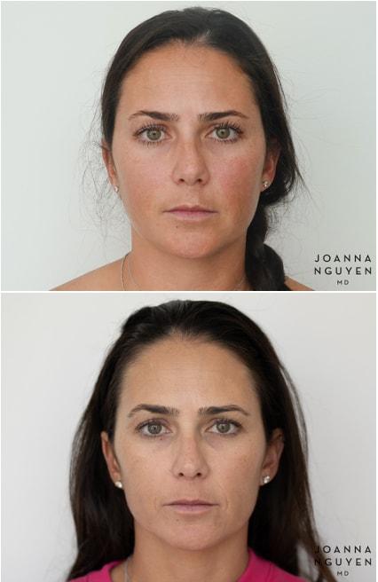 Rhinoplasty result at JoAnna Nguyen, MD in West Hollywood, CA