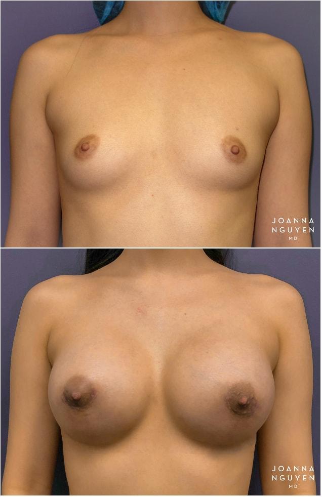 Breast Augmentation result at JoAnna Nguyen, MD in West Hollywood, CA
