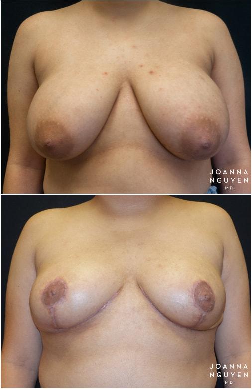 JoAnna Nguyen, MD breast reduction result — West Hollywood, CA