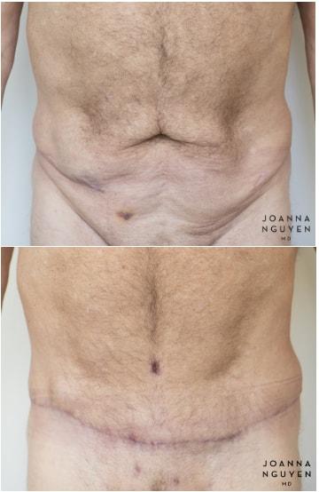 Mini Tummy Tuck result at JoAnna Nguyen, MD in West Hollywood, CA