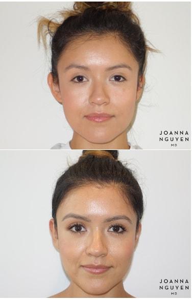 JoAnna Nguyen, MD ear pinning result — West Hollywood, CA