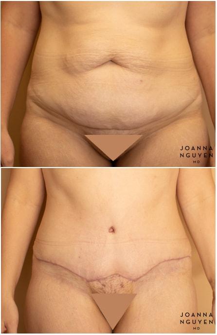 Mini Tummy Tuck result at JoAnna Nguyen, MD in West Hollywood, CA