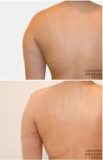Liposuction result at JoAnna Nguyen, MD in West Hollywood, CA