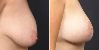 Christian Guzman, MD breast augmentation result — Harrison, NY