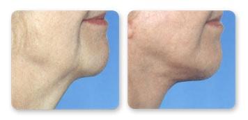 Christian Guzman, MD facelift result — Harrison, NY