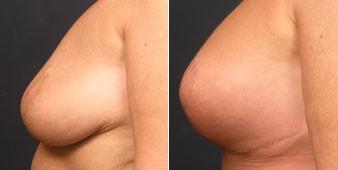 Christian Guzman, MD breast augmentation result — Harrison, NY