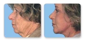 Christian Guzman, MD facelift result — Harrison, NY