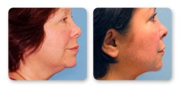 Christian Guzman, MD facelift result — Harrison, NY