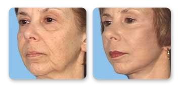 Christian Guzman, MD facelift result — Harrison, NY
