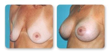 Christian Guzman, MD breast augmentation result — Harrison, NY