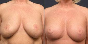 Christian Guzman, MD breast lift result — Harrison, NY