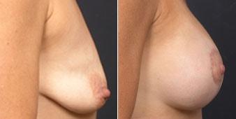 Christian Guzman, MD breast augmentation result — Harrison, NY