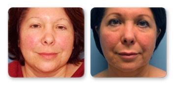Christian Guzman, MD facelift result — Harrison, NY