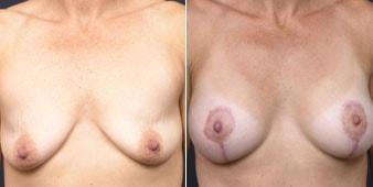 Christian Guzman, MD breast lift result — Harrison, NY