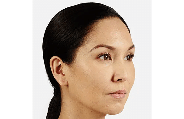 Juvederm after at Pure Med Spa in Chicago, IL