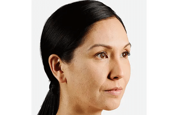 Juvederm before at Pure Med Spa in Chicago, IL