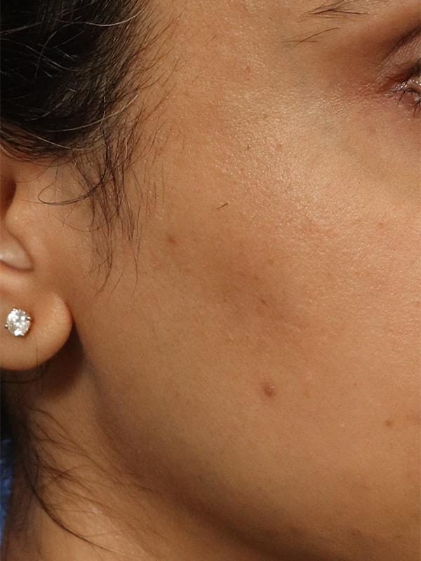 Renata Facial Cosmetic Surgery (Renata Khelemsky, MD) scar treatment after — Brooklyn, NY