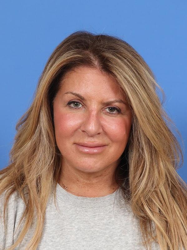 Renata Facial Cosmetic Surgery (Renata Khelemsky, MD) facelift after — Brooklyn, NY