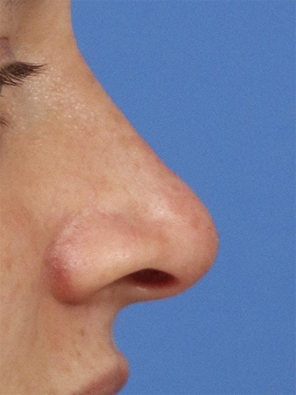 Renata Facial Cosmetic Surgery (Renata Khelemsky, MD) liquid rhinoplasty after — Brooklyn, NY