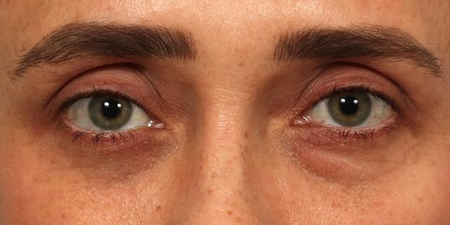 Blepharoplasty before at Renata Facial Cosmetic Surgery (Renata Khelemsky, MD) in Brooklyn, NY