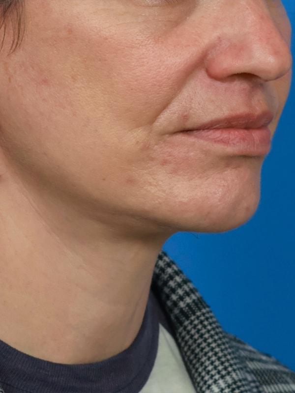 Renata Facial Cosmetic Surgery (Renata Khelemsky, MD) facelift after — Brooklyn, NY