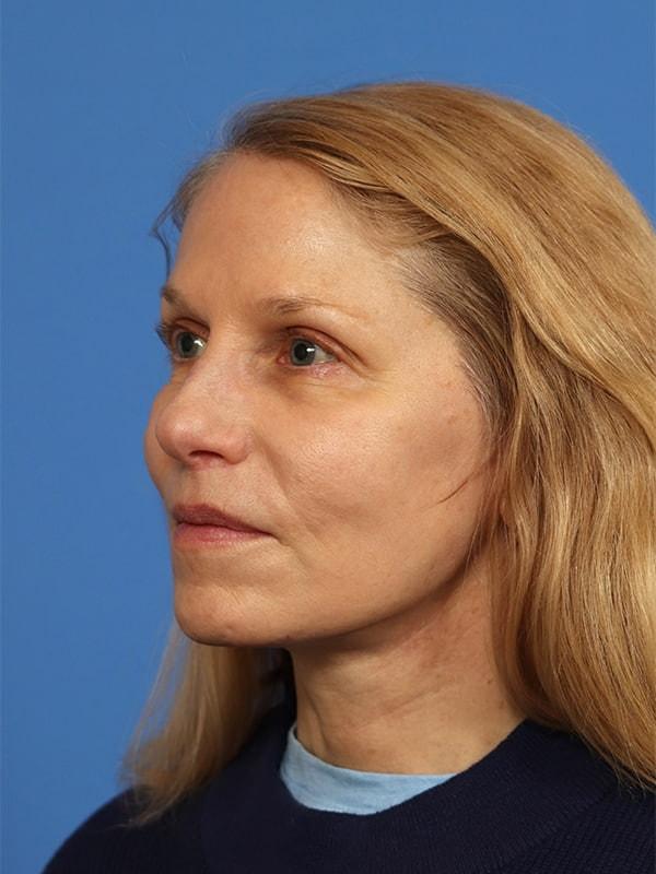 Renata Facial Cosmetic Surgery (Renata Khelemsky, MD) facelift after — Brooklyn, NY