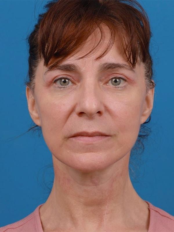 Renata Facial Cosmetic Surgery (Renata Khelemsky, MD) facelift after — Brooklyn, NY